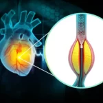 Cardiovascular Disease Effects in Respiratory Patients